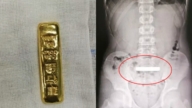 驚險！大陸11歲男孩把100克金條吞入腹中