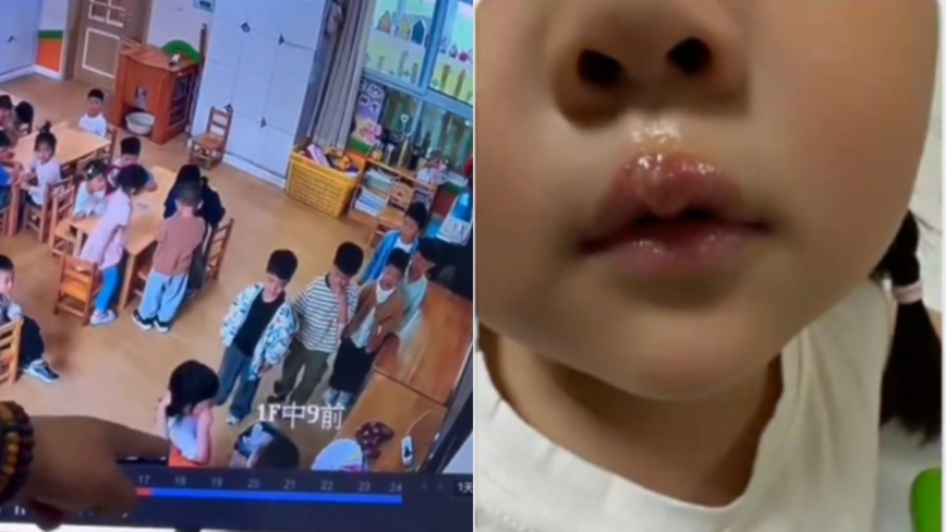 江苏幼儿园老师虐童 用热熔胶烫孩子嘴唇(视频)